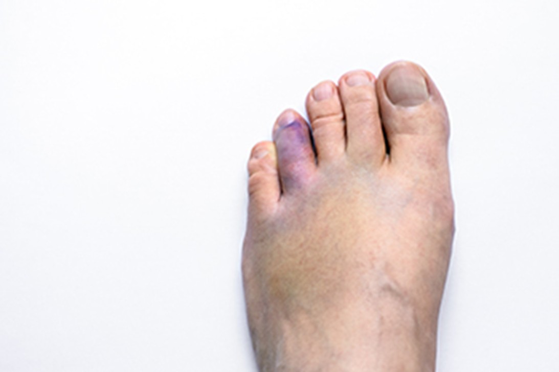 broken toe