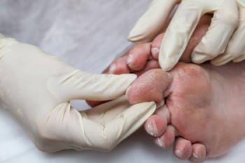 diabetic feet