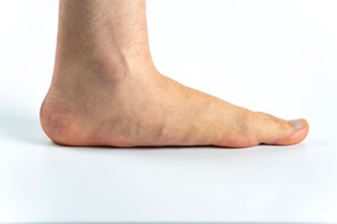 flatfeet