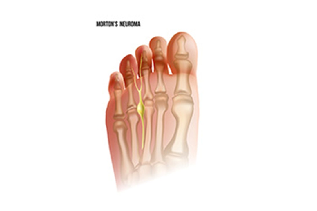 neuroma