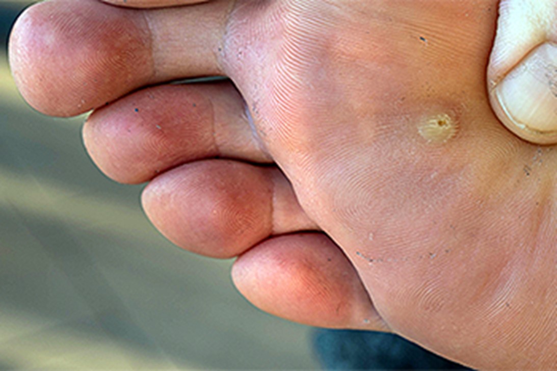 plantar warts