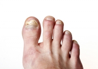 Lowering Your Chances of Toenail Fungus