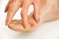 Bunions Can Be Mild or Severe